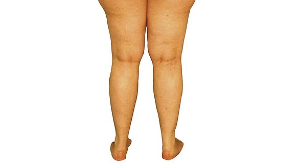 Pernas edematosas gravidez
